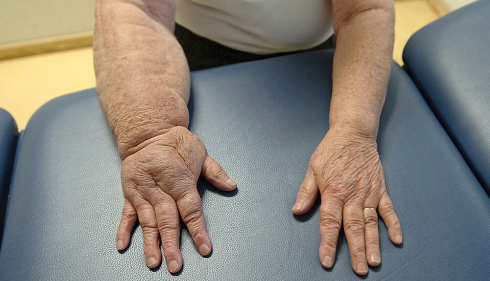 forms-of-lymphedema-2